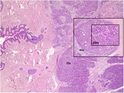 Case Report: A challenging diagnosis of an apocrine sweat gland carcinoma